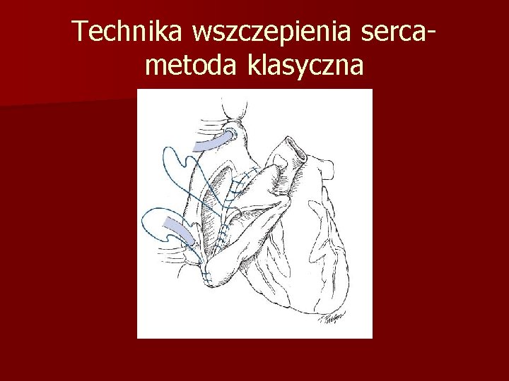 Technika wszczepienia sercametoda klasyczna 