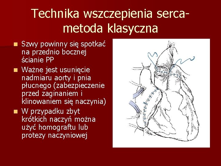 Technika wszczepienia sercametoda klasyczna Szwy powinny się spotkać na przednio bocznej ścianie PP n