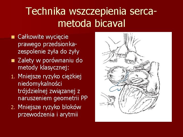 Technika wszczepienia sercametoda bicaval Całkowite wycięcie prawego przedsionkazespolenie żyła do żyły n Zalety w