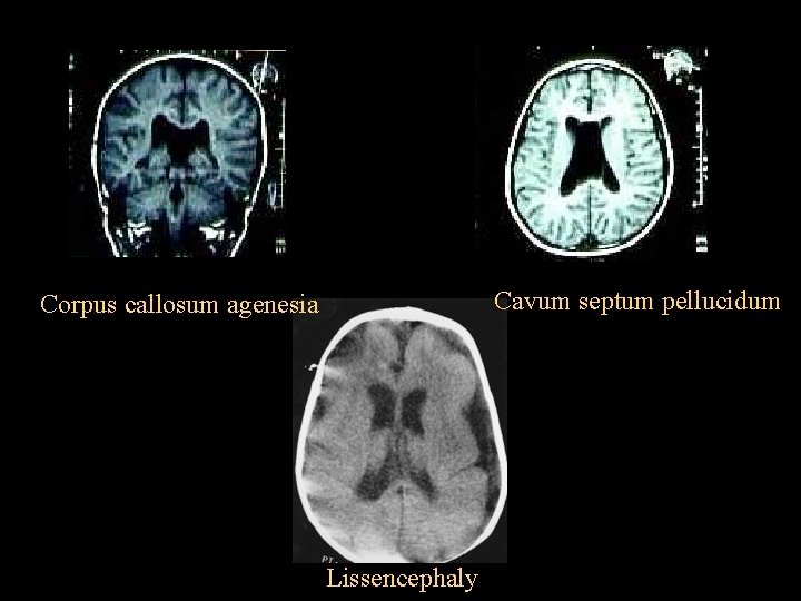 Cavum septum pellucidum Corpus callosum agenesia Lissencephaly 