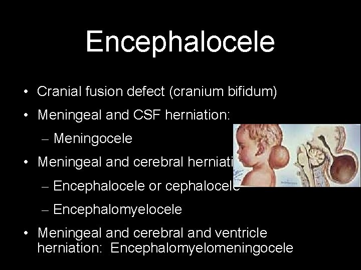 Encephalocele • Cranial fusion defect (cranium bifidum) • Meningeal and CSF herniation: – Meningocele
