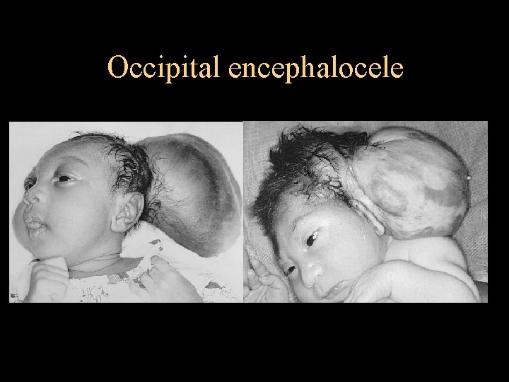Occipital encephalocele 
