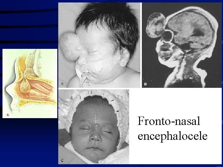 Fronto-nasal encephalocele 