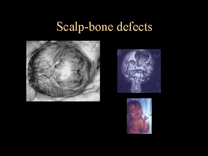 Scalp-bone defects 