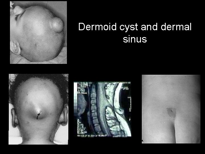 Dermoid cyst and dermal sinus 