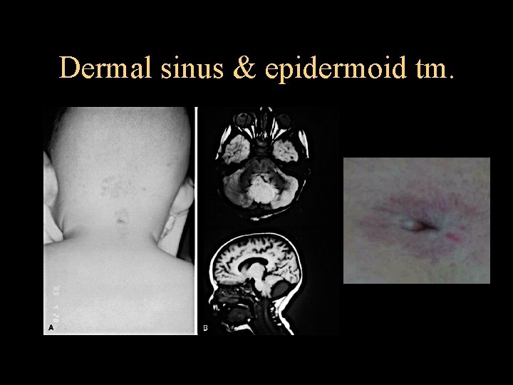 Dermal sinus & epidermoid tm. 