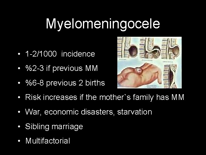 Myelomeningocele • 1 -2/1000 incidence • %2 -3 if previous MM • %6 -8