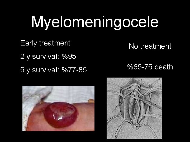 Myelomeningocele Early treatment No treatment 2 y survival: %95 5 y survival: %77 -85