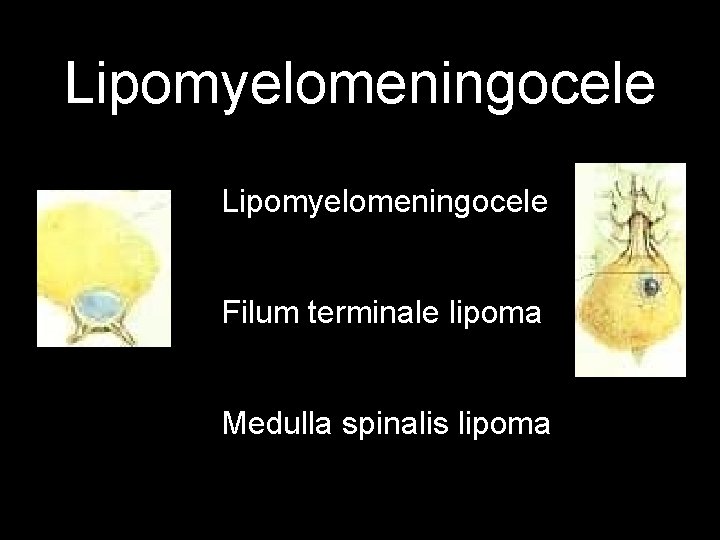 Lipomyelomeningocele Filum terminale lipoma Medulla spinalis lipoma 