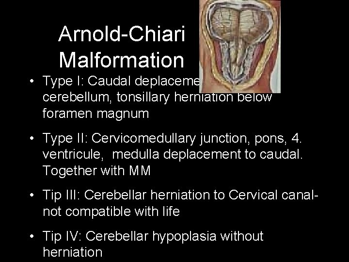 Arnold-Chiari Malformation • Type I: Caudal deplacement of the cerebellum, tonsillary herniation below foramen