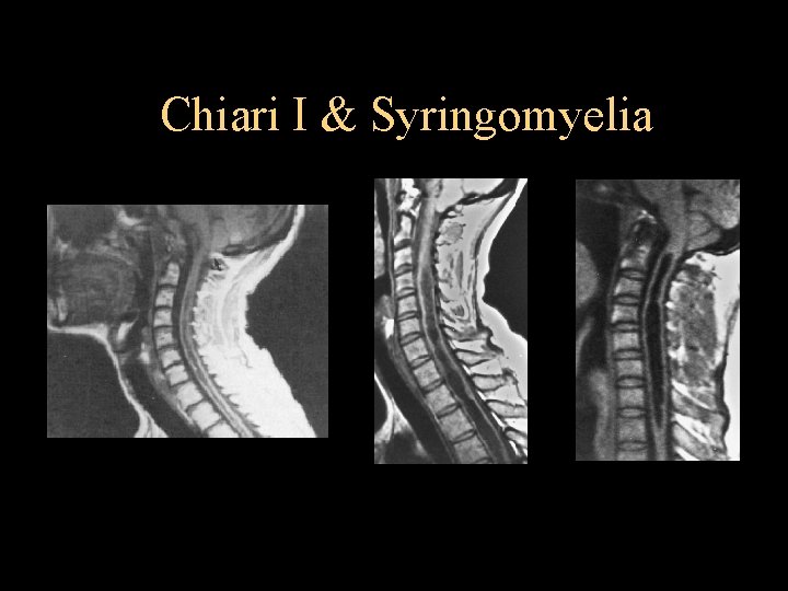 Chiari I & Syringomyelia 