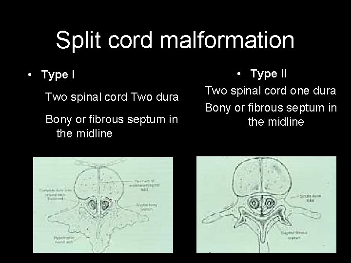 Split cord malformation • Type I Two spinal cord Two dura Bony or fibrous