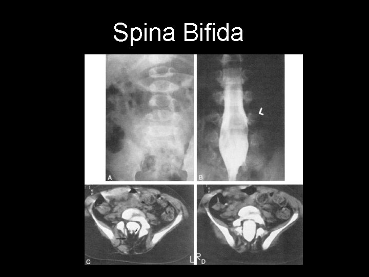 Spina Bifida 