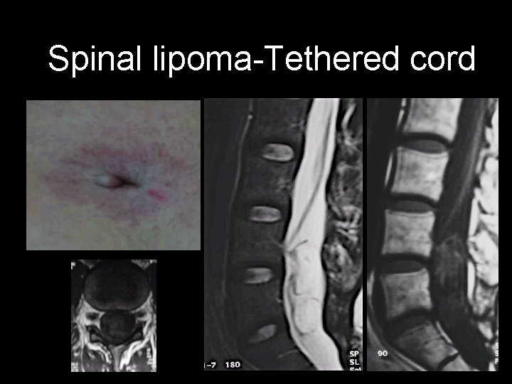 Spinal lipoma-Tethered cord 