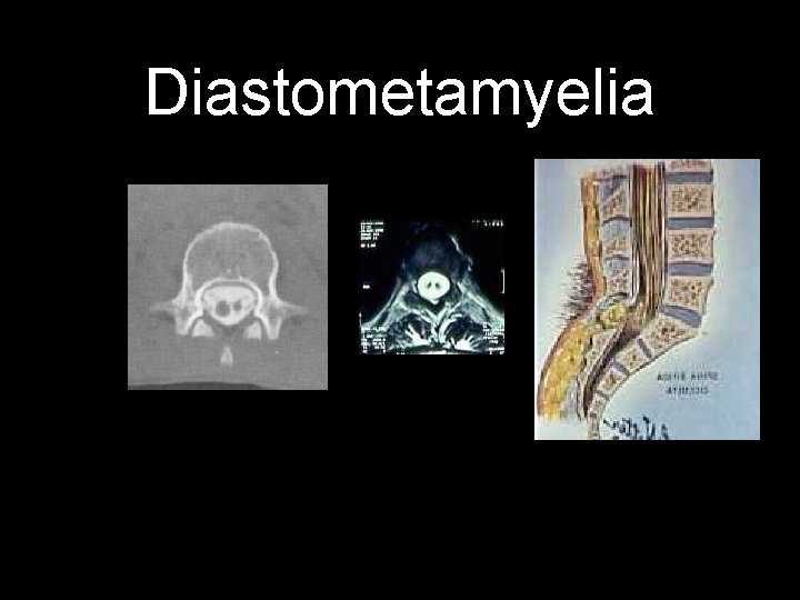 Diastometamyelia 