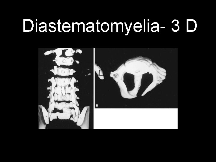Diastematomyelia- 3 D 