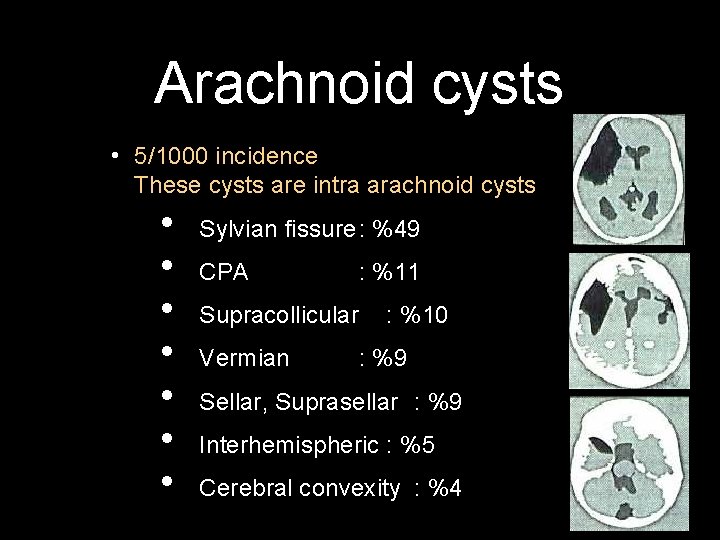 Arachnoid cysts • 5/1000 incidence These cysts are intra arachnoid cysts • • Sylvian