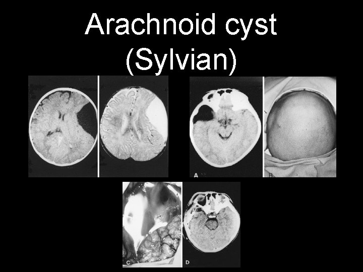 Arachnoid cyst (Sylvian) 