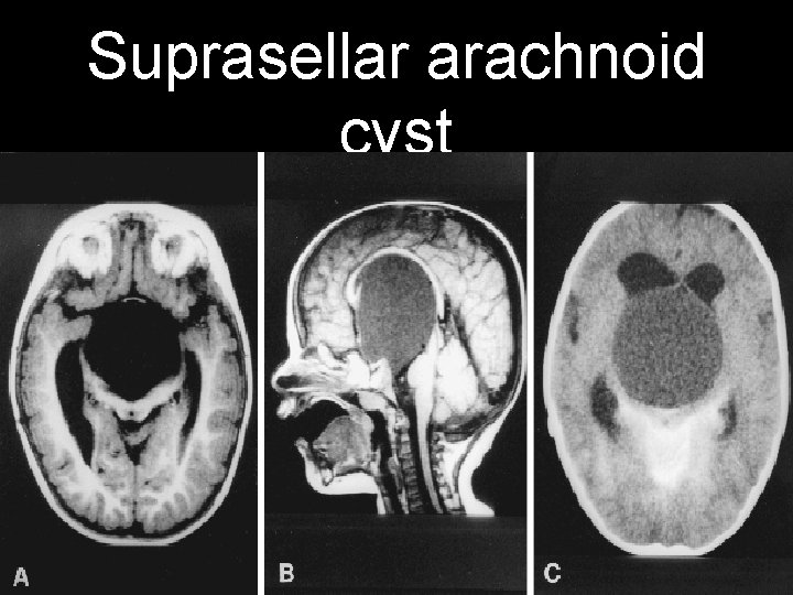 Suprasellar arachnoid cyst 