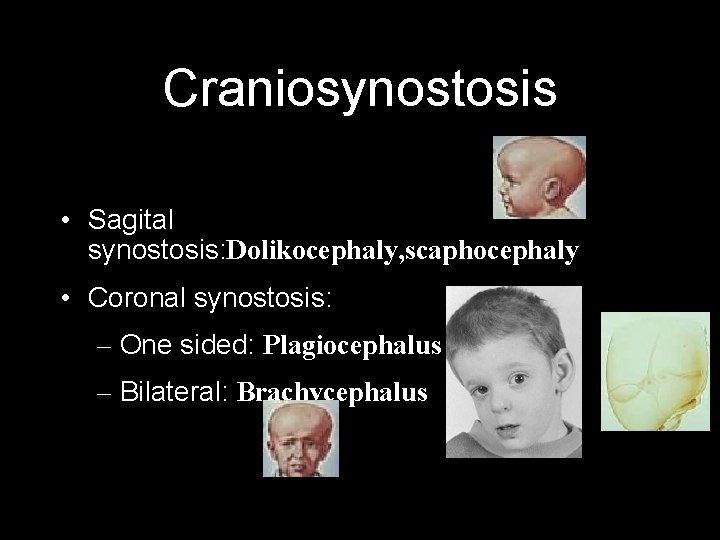 Craniosynostosis • Sagital synostosis: Dolikocephaly, scaphocephaly • Coronal synostosis: – One sided: Plagiocephalus –