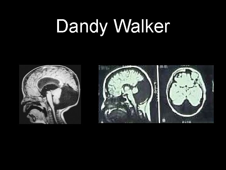 Dandy Walker 