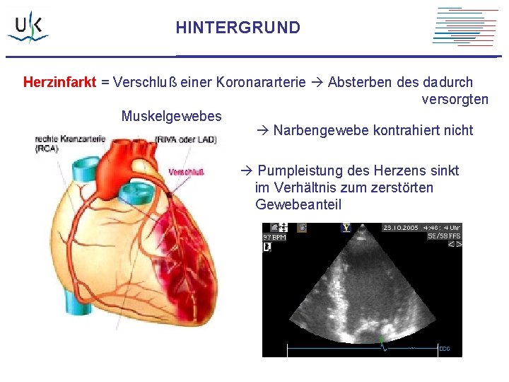 HINTERGRUND Herzinfarkt = Verschluß einer Koronararterie Absterben des dadurch versorgten Muskelgewebes Narbengewebe kontrahiert nicht