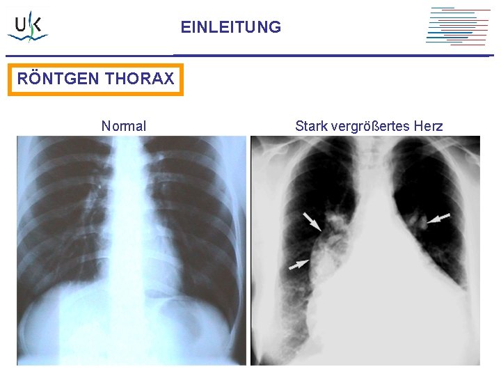 EINLEITUNG RÖNTGEN THORAX Normal Stark vergrößertes Herz 