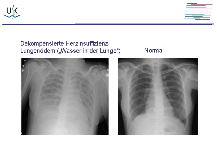 Dekompensierte Herzinsuffizienz Lungenödem („Wasser in der Lunge“) Normal 