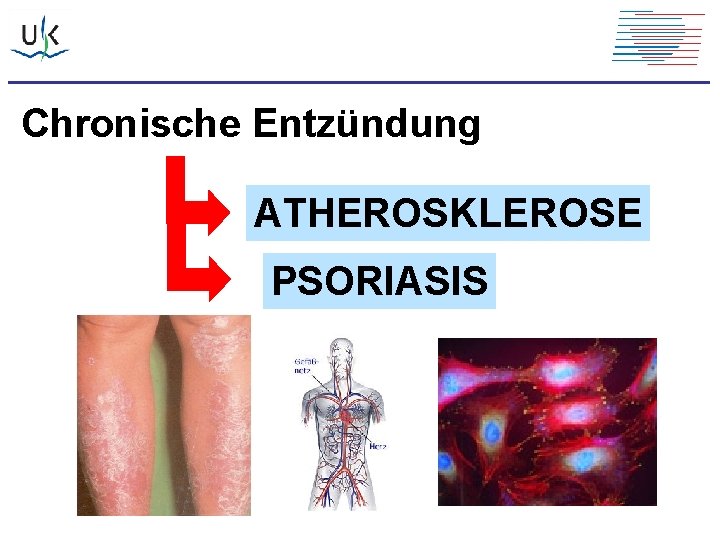 Chronische Entzündung ATHEROSKLEROSE PSORIASIS 