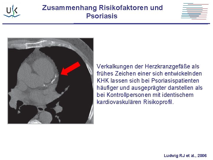 Zusammenhang Risikofaktoren und Psoriasis Verkalkungen der Herzkranzgefäße als frühes Zeichen einer sich entwickelnden KHK