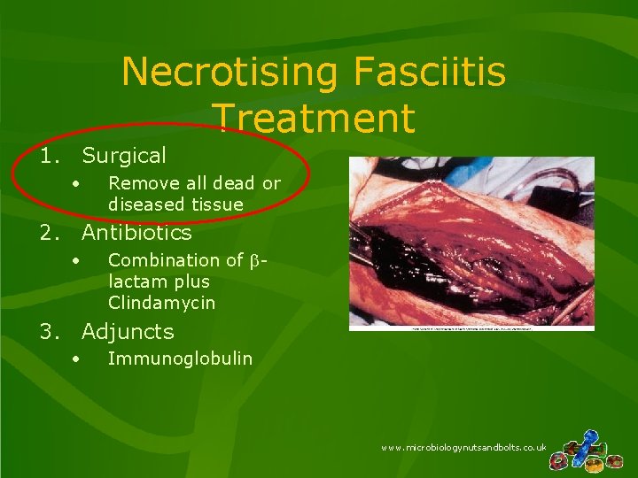 Necrotising Fasciitis Treatment 1. Surgical • Remove all dead or diseased tissue 2. Antibiotics