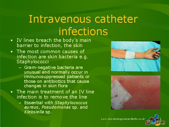 Intravenous catheter infections • IV lines breach the body’s main barrier to infection, the