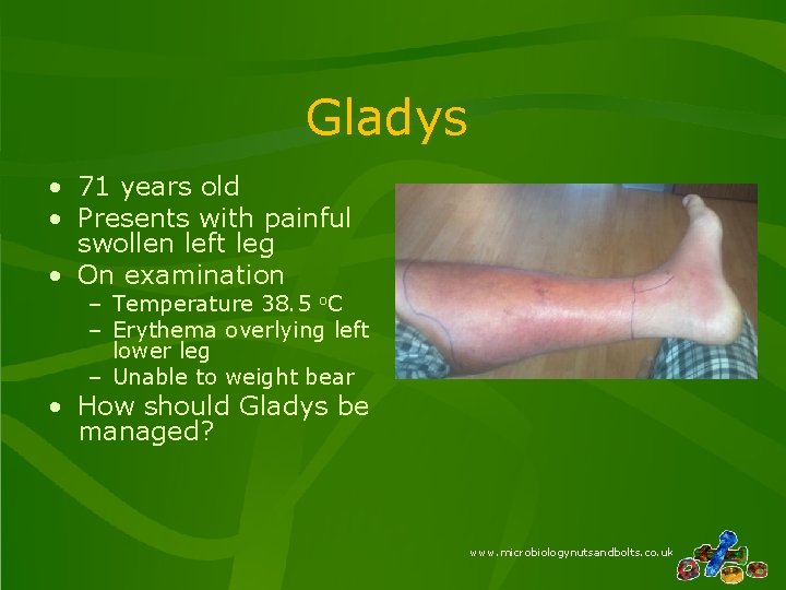 Gladys • 71 years old • Presents with painful swollen left leg • On