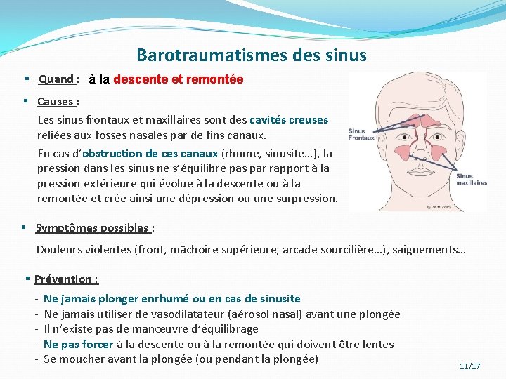 Barotraumatismes des sinus § Quand : à la descente et remontée § Causes :