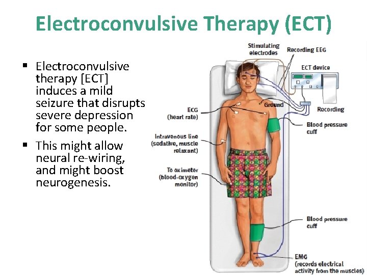 Electroconvulsive Therapy (ECT) § Electroconvulsive therapy [ECT] induces a mild seizure that disrupts severe