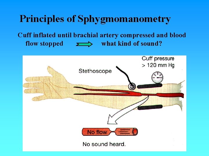 Principles of Sphygmomanometry Cuff inflated until brachial artery compressed and blood flow stopped what Principles of Sphygmomanometry Cuff inflated until brachial artery compressed and blood flow stopped what