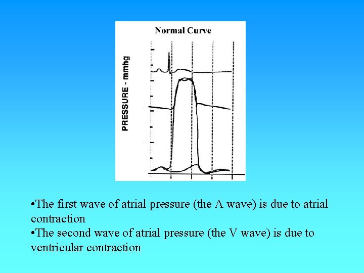 • The first wave of atrial pressure (the A wave) is due to • The first wave of atrial pressure (the A wave) is due to