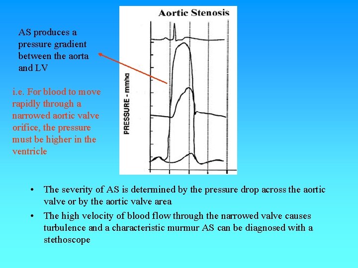 AS produces a pressure gradient between the aorta and LV i. e. For blood AS produces a pressure gradient between the aorta and LV i. e. For blood