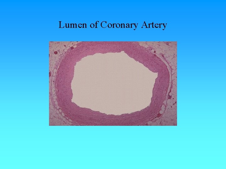 Lumen of Coronary Artery Lumen of Coronary Artery