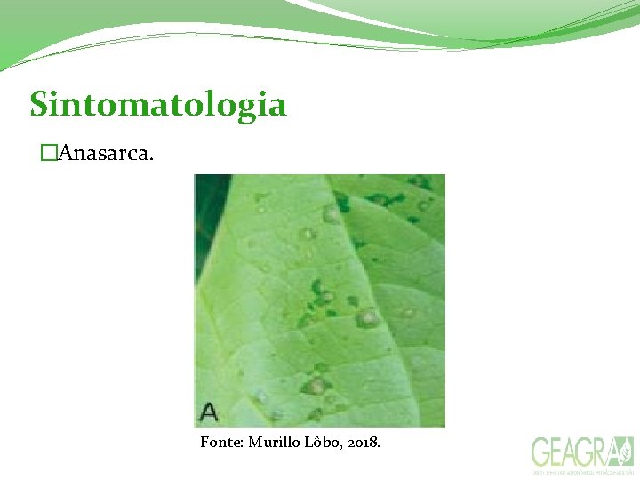 Sintomatologia �Anasarca. Fonte: Murillo Lôbo, 2018. 