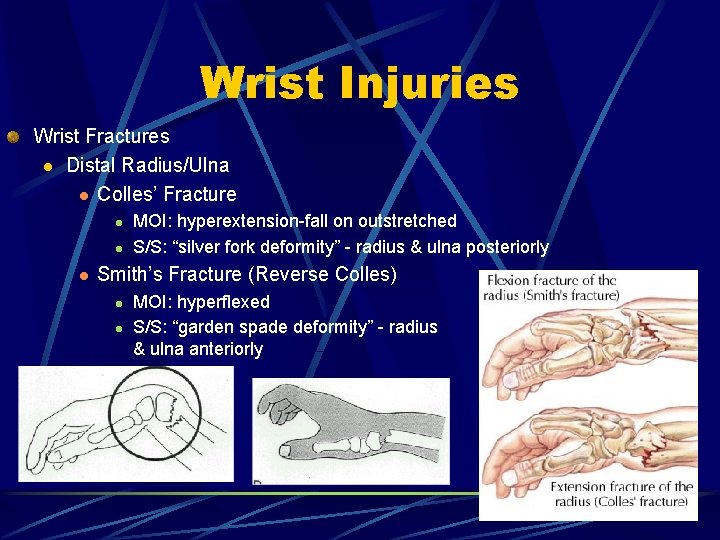 Wrist Injuries Wrist Fractures l Distal Radius/Ulna l Colles’ Fracture l l l MOI: