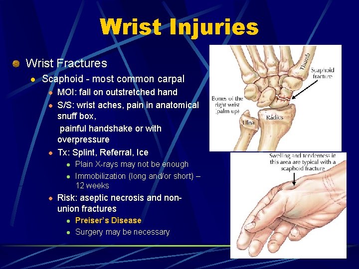 Wrist Injuries Wrist Fractures l Scaphoid - most common carpal l MOI: fall on