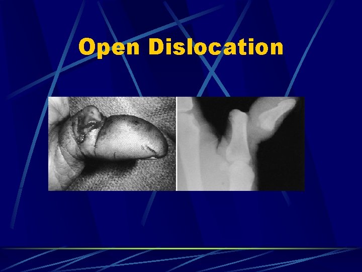Open Dislocation 