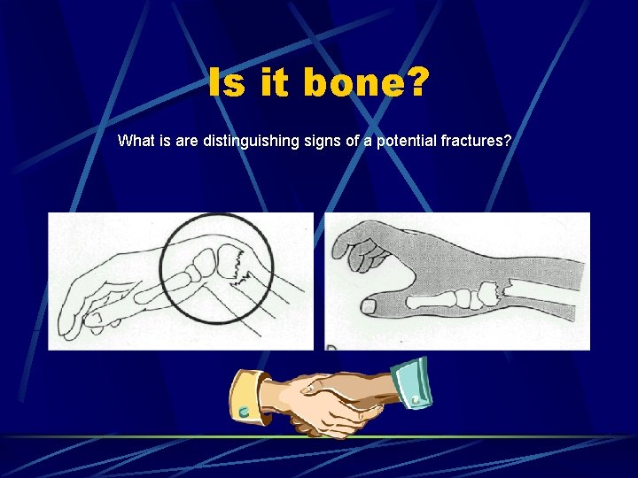 Is it bone? What is are distinguishing signs of a potential fractures? 