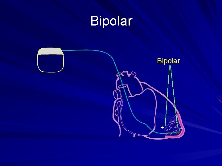 Bipolar + _ 