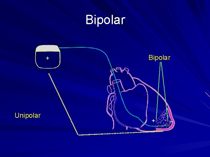 Bipolar + Unipolar Bipolar + _ 