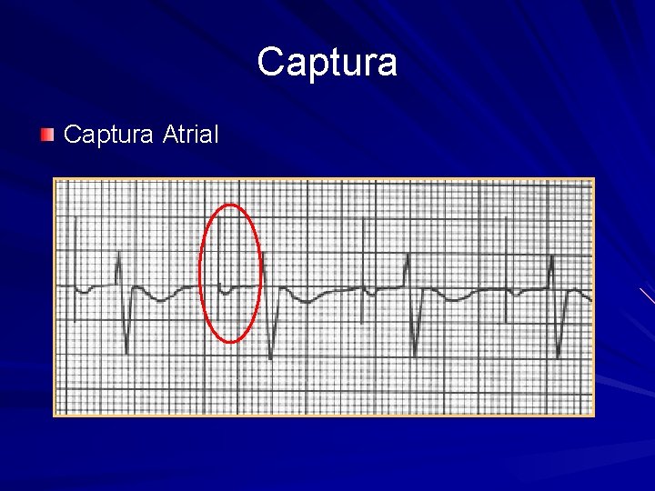 Captura Atrial 