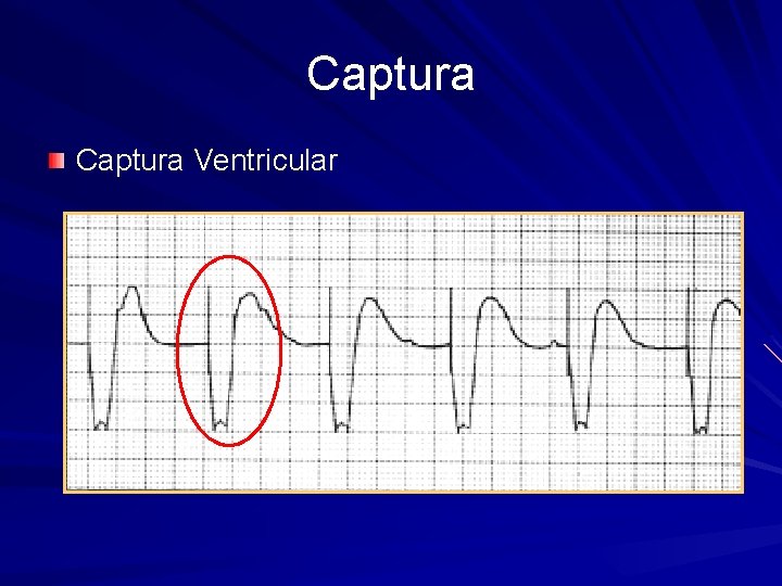 Captura Ventricular 