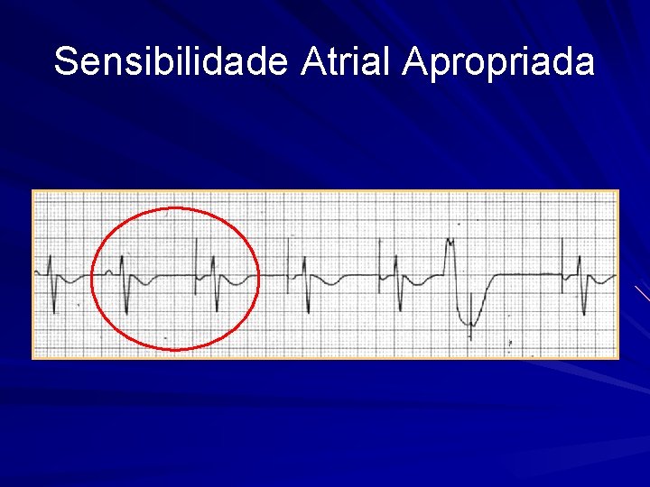 Sensibilidade Atrial Apropriada 