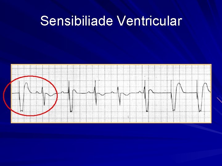 Sensibiliade Ventricular 